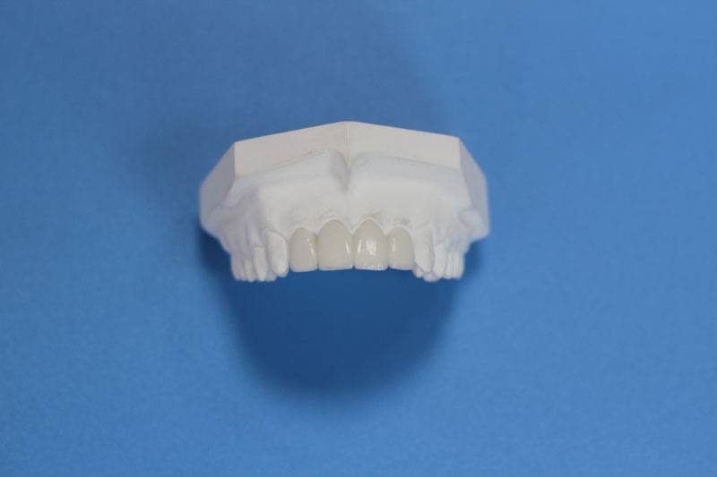 Global Dental Lab: Porcelain Veneers 2