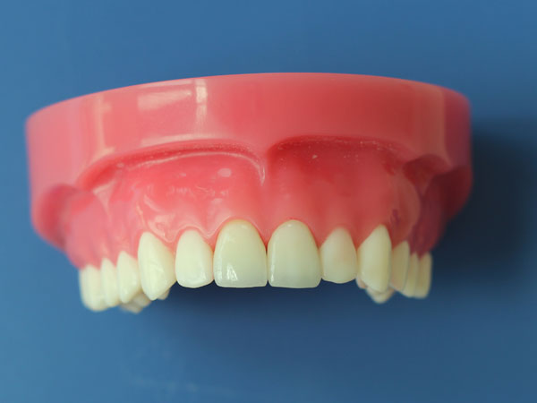 Global Dental Lab: Acrylic Partial 2