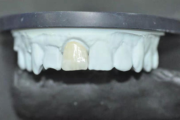 Global Dental  Lab: Ceramic Zirconia 2