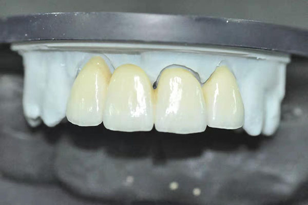 Global Dental  Lab: Ceramic Zirconia 4