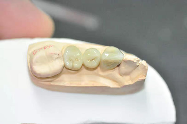 Global Dental  Lab: Ceramic Zirconia 5