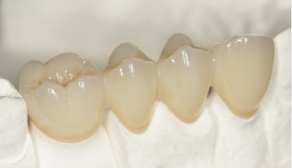 Global Dental  Lab: E.max All-Ceramic Dental 1