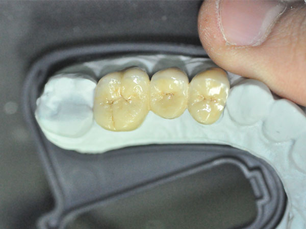 Global Dental  Lab: Procelain Fused to Metal 2