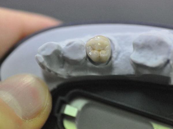 Global Dental  Lab: Procelain Fused to Metal 3