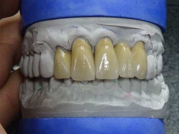 Global Dental  Lab: Procelain Fused to Metal 4