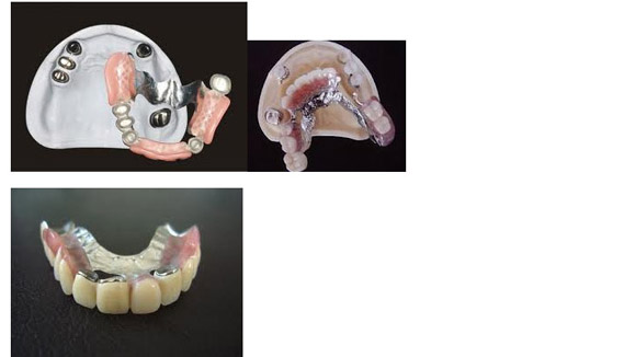 Global Dental Lab: Telescopic Dental Crown 2