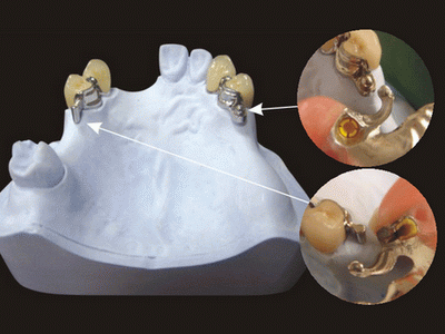 Global Dental Lab: Precision Attachment Repair 10
