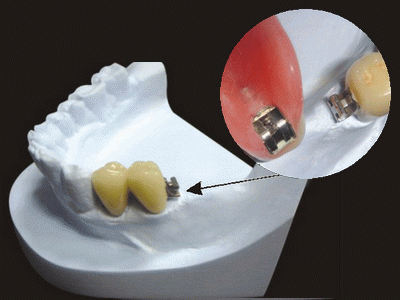 Global Dental Lab: Precision Attachment Repair 11