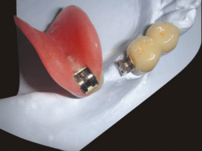 Global Dental Lab: Precision Attachment Repair 12