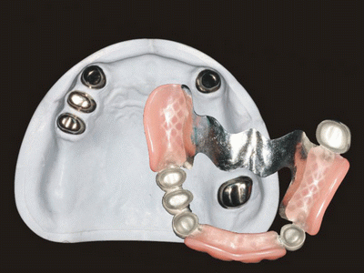 Global Dental Lab: Precision Attachment Repair 2