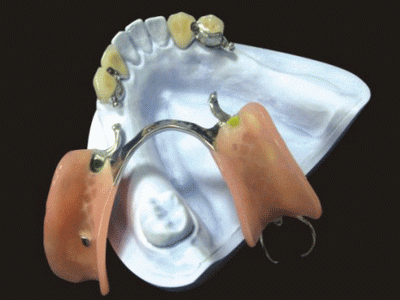 Global Dental Lab: Precision Attachment Repair 3