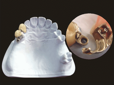 Global Dental Lab: Precision Attachment Repair 4
