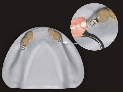 Global Dental Lab: Precision Attachment Repair 5