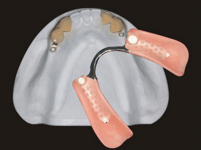 Global Dental Lab: Precision Attachment Repair 6