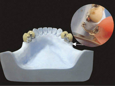 Global Dental Lab: Precision Attachment Repair 7