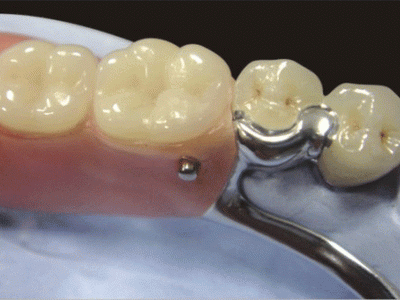 Global Dental Lab: Precision Attachment Repair 8