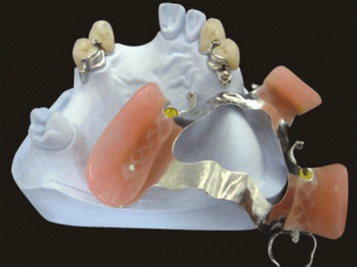 Global Dental Lab: Precision Attachment Repair 9