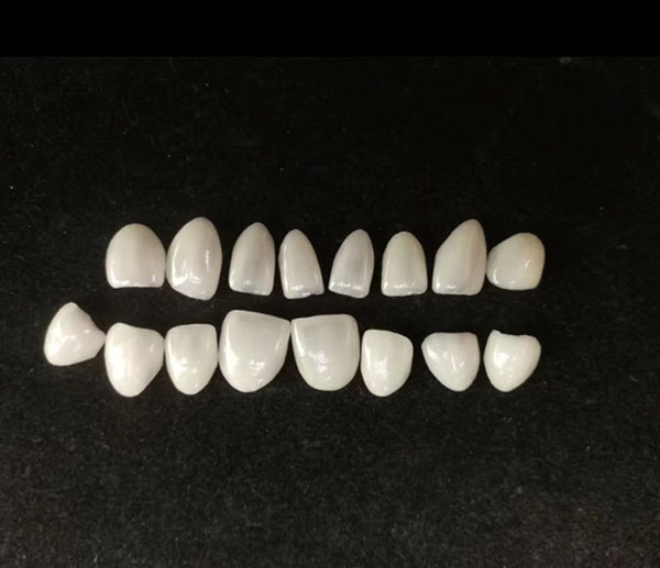 Porcelain Veneers 1